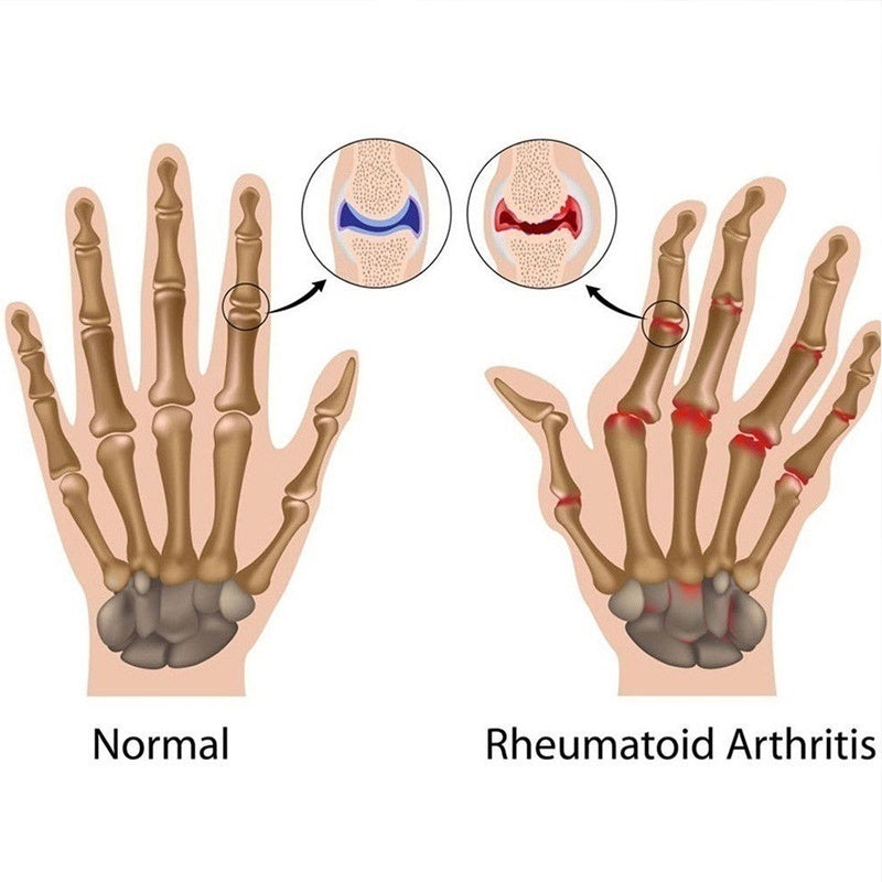 Arthritis Compression Gloves